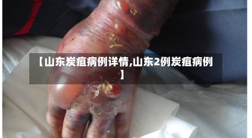 【山东炭疽病例详情,山东2例炭疽病例】